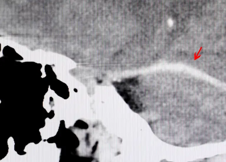 an x - ray of a person's head with a red arrow in the