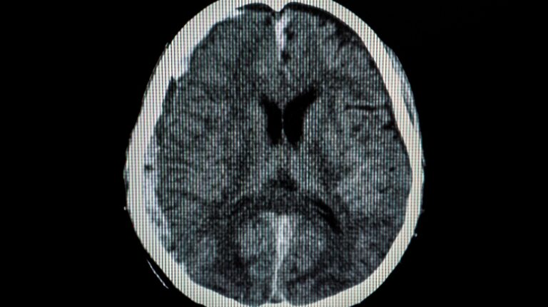 CT scan of a brain of a patient