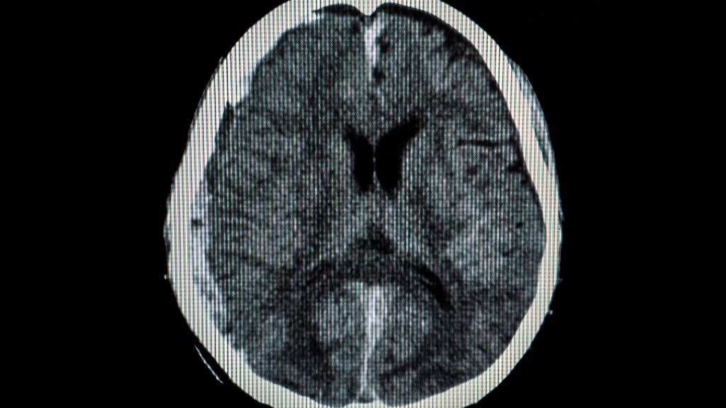 CT scan of a brain of a patient
